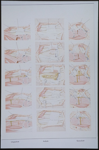 Picture: Operation einer distal intraartikulären Radiusfraktur, Handgelenkbruch (Abschlussarbeit 1992)