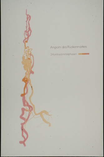 Picture: Angiom des Rückenmarkes