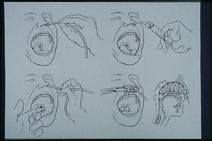 Bild:  Medizinische Illustration: Kiefer-Chirurgie