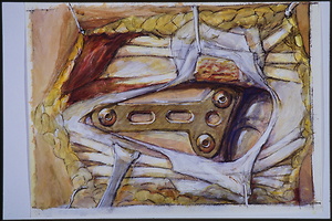 Bild:  Operation einer distal intraartikulären Radiusfraktur, Handgelenkbruch (Abschlussarbeit 1992)