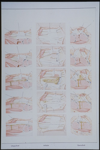 Bild:  Operation einer distal intraartikulären Radiusfraktur (Handgelenkbruch)
